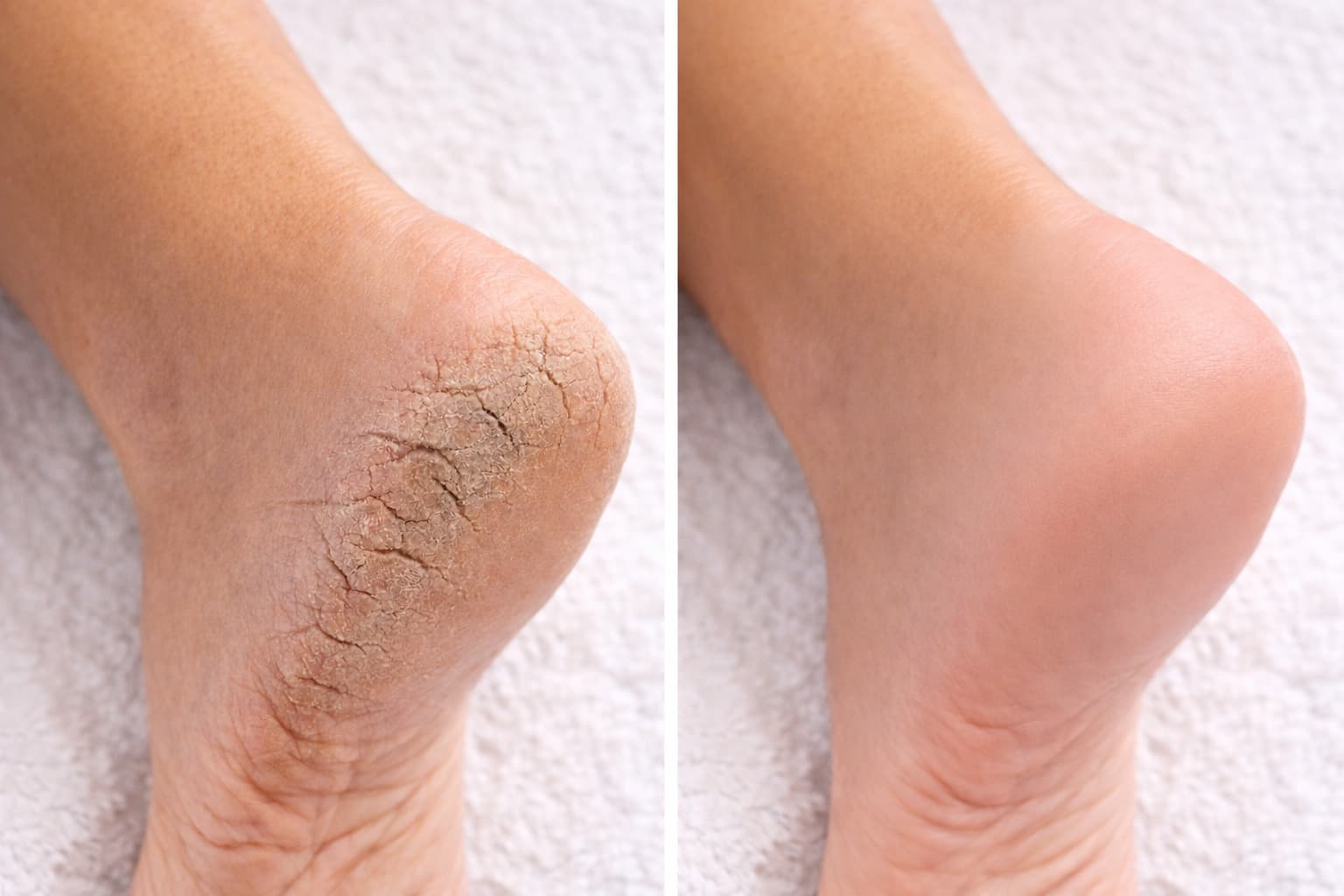 Before and after comparison showing professional foot care results by Superior Steppers — restored, healthy heels